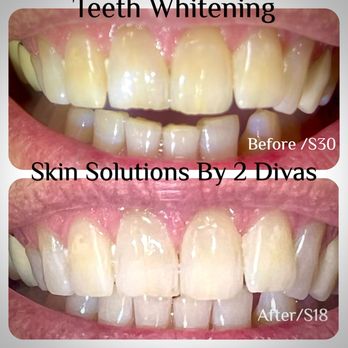 Skin Solutions by 2 Divas - Teeth Whitening Near Me - Stuart, Florida