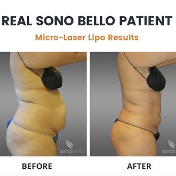 Sono Bello - Cosmetic Surgeons Near Me - Tacoma, Washington