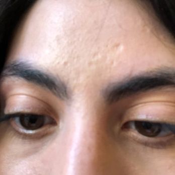 Matahari Skin Solutions - Before Deep acne scar on forehead - Skin Care Near Me - San Francisco, California