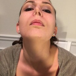 WellStar Medical Group ENT - Right nostril collapsed