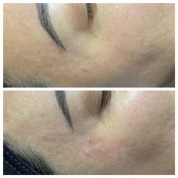 Esthetics by Marissa - Custom skin therapy session (before shot shown below)