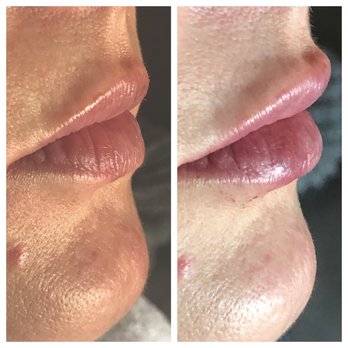 OmniaPiel - Very natural lip injections with Voluma. - Skin Care Near Me - Costa Mesa, California
