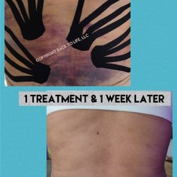 Back to Life - After surgery pain, bruising, and swelling reduced in one treatment. #liposuction #tummy tuck #mommy makeover