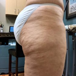 Suddenly Slimmer - 12/18 client before one full body supreme wrap