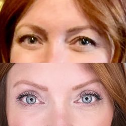 Front Range Plastic Surgery - Before and after - upper blepharoplasty