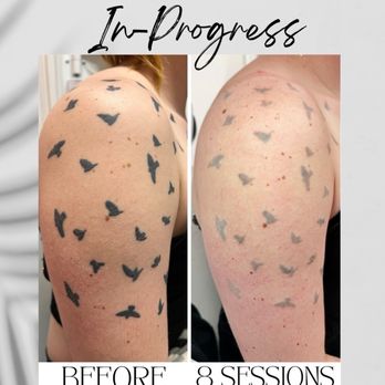 glutathione taken at night Laser Tattoo Removal in Seattle