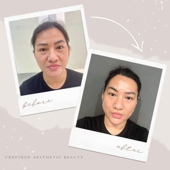 Redefined Brows and Beauty - COG Thread Face Lift - a non surgical face lift that will give you instant result. - Eyebrow Services Near Me Redefined Brows and Beauty - COG Thread Face Lift - a non surgical face lift that will give you instant result. - Eyebrow Services Near Me