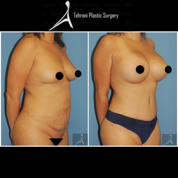 Tehrani Plastic Surgery - Breast Augmentation and Abdominoplasty performed by Dr. T - Medical Spas Near Me - San Diego, California