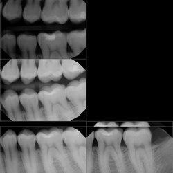 Alan S. Levy - Tooth filling