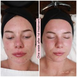 Skin With Bea Esthetics - One week after advanced acne treatment