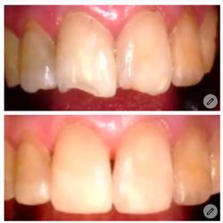 Perfect Smiles Family Dentistry - Conservative restoration of fractured teeth with tooth colored filling