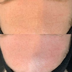 Kanary Naturals - Post facial results