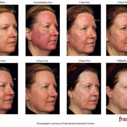 Daniel Behroozan, MD, FAAD, FACMS - FDA-approved, Fraxel aims to reduce the appearance of fine lines and wrinkles, skin pigmentation, sun damage and acne