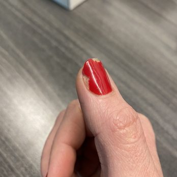 O Nail Spa - Close up of thumb, completely cracked multiple ways, which then started chipping in chunks - Nail Salons Near Me - Sherman Oaks, California O Nail Spa - Close up of thumb, completely cracked multiple ways, which then started chipping in chunks - Nail Salons Near Me - Sherman Oaks, California