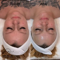 Idan Med Spa - Salmon DNA facial before and after