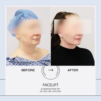 Heavenly Plastic Surgery - Before and after - Plastic Surgeons Near Me - Lake Forest, California Heavenly Plastic Surgery - Before and after - Plastic Surgeons Near Me - Lake Forest, California