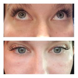 Facette Medical Spa - Tear troughs fill with PRFM/PRP by Mina @ Facette Medical Spa