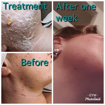 Experience Your Wellness - Acne treatment - Estheticians Near Me - Amsterdam, New Hampshire