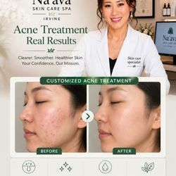 Acne treatment