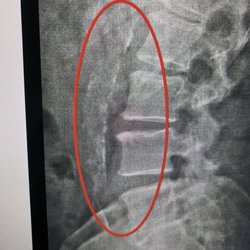 Orange Wellness - The discovery X-ray. In the red circle, along the spine, is a white segmented vertical line. "Hardening of the arteries".