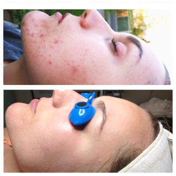 Tachi Skin Care - before and after - Skin Care Near Me - Medford, Oregon Tachi Skin Care - before and after - Skin Care Near Me - Medford, Oregon