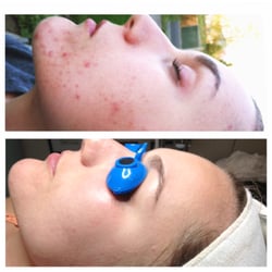 Tachi Skin Care - Before and after