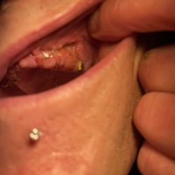 Brisman Implant and Oral Surgery - PLANTS WHICH FAILED PLACES INCORRECTLY