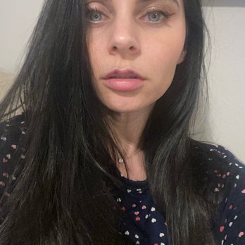 DNAge Medical - Post filler. Minor bruising. I bruise easily. But obsessed. - Medical Spas Near Me - Miami, Florida DNAge Medical - Post filler. Minor bruising. I bruise easily. But obsessed. - Medical Spas Near Me - Miami, Florida