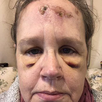 Novus Clinic - Blisters - Ophthalmologists Near Me - Tallmadge, Ohio Novus Clinic - Blisters - Ophthalmologists Near Me - Tallmadge, Ohio