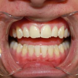 Dana M Nichols, DMD - Before pic (actual patient) of chipped front teeth.