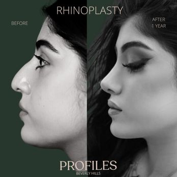 Profiles Beverly Hills Plastic Surgery - Rhinoplasty - Plastic Surgeons Near Me - Beverly Hills, California