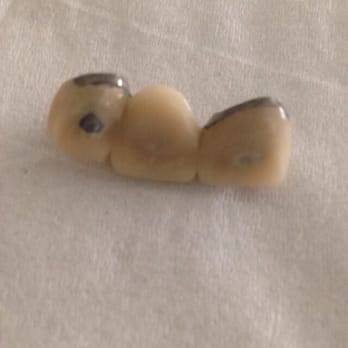 Arpit Mody, DDS - 3 tooth bridge suppose to be none metal he said. Got it removed as you can see its metal. - Cosmetic Dentists Near Me - Warren, Michigan Arpit Mody, DDS - 3 tooth bridge suppose to be none metal he said. Got it removed as you can see its metal. - Cosmetic Dentists Near Me - Warren, Michigan