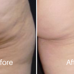 Legacy Aesthetics - Cellulite Reduction Treatment