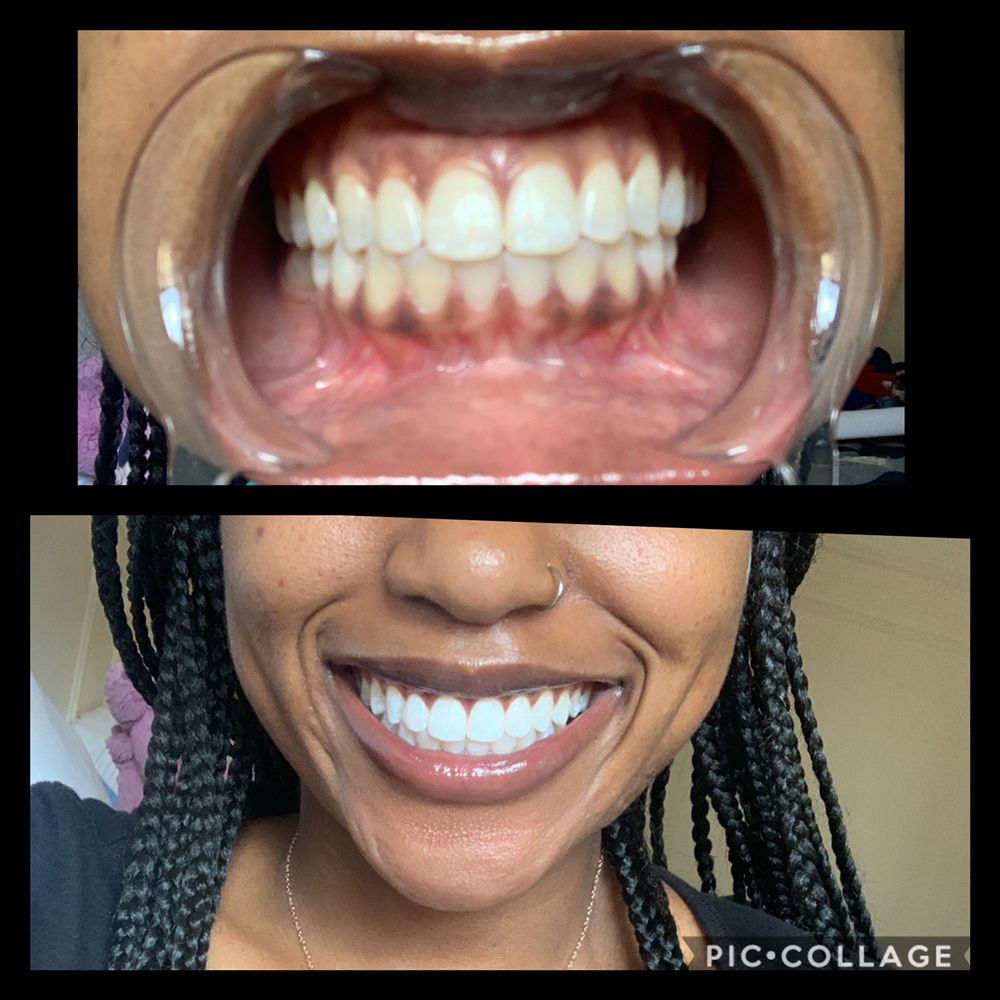 CHLO’VAMPED Teeth Whitening The Bronx, NY Phone Number Yelp