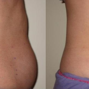 Ballard Gynecology - Treatment with truSculpt - Obstetricians & Gynecologists Near Me - Rapid City, South Dakota Ballard Gynecology - Treatment with truSculpt - Obstetricians & Gynecologists Near Me - Rapid City, South Dakota
