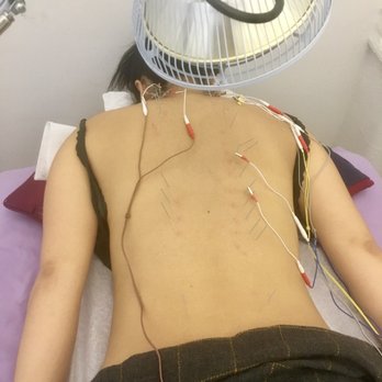 Hima Acupuncture - Manhattan - Archipancture treatment with electric-stim machine.  Infrared heat lamp kept my back warm during treatment! - Acupuncture Near Me - New York, New York