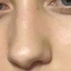 Ear Nose & Throat Centers Of North Texas - Before- before surgery can see deviated septum on left side