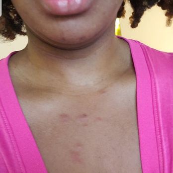 SpringHill Suites by Marriott Naples - Bites from the bed bugs! - Hotels Near Me - Naples, Florida
