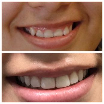 Katrina Le, DDS - top: original smile bottom: smile after invisalign with 2 cosmetic crowns on the front 2 teeth, and bonding on the outer 2 teeth. - General Dentistry Near Me - Sunnyvale, California