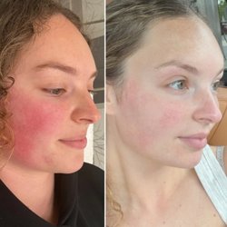 Rosacea Treatment with Patriot's Wife