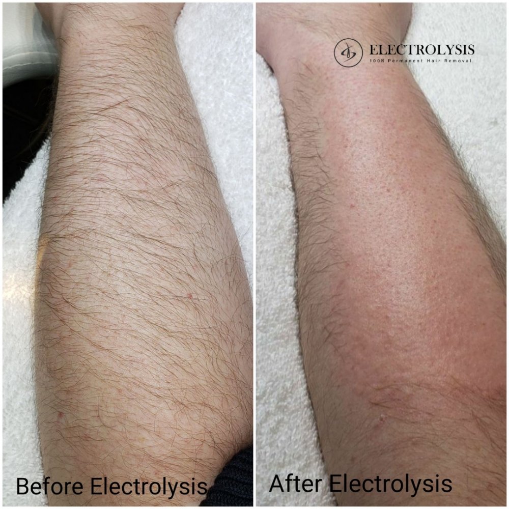 ELECTROLYSIS 100 PERMANENT HAIR REMOVAL Updated August 2024 29