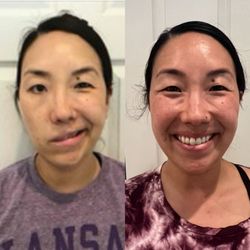 Kim Peirano - Got my smile back--never felt better!