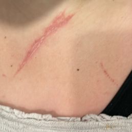 Deep gash in her chest area