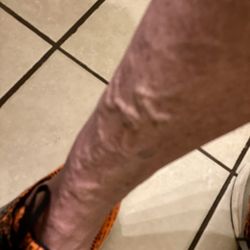 Texas Vascular Institute - One year after several treatments. Doesn't appear to look any better.