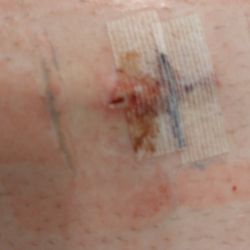 St. Francis Regional Medical Center - Incision improperly bandaged to heal without having a big scar.