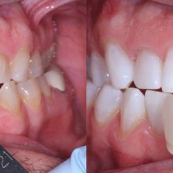 Lifetime Dental - Before & After at Lifetime Dental | Boerne, TX