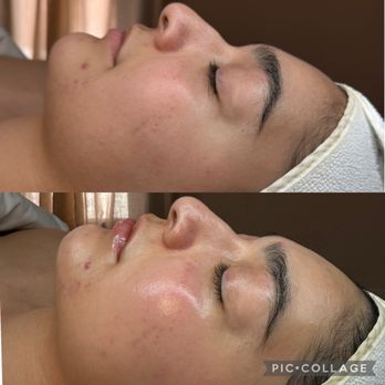 Evolution Skyn Aesthetics - before and after - Skin Care Near Me - Riverside, California