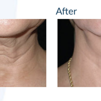 Laser Esthetica - Skin Tightening: Before & After - Medical Spas Near Me - Roseville, California Laser Esthetica - Skin Tightening: Before & After - Medical Spas Near Me - Roseville, California