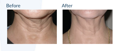 Skin Tightening (Morpheus8) - Morpheus8 in Roseville is a state-of-the-art solution for anyone looking to address a variety of frustrating skin issues. This cutting-edge treatment combines microneedling with radiofrequency (RF) energy to provide enhanced collagen-building results. While Morpheus8 is typically a face and neck treatment, it can be used on a number of other areas to address issues like sagging skin.

Morpheus8 offers numerous benefits:
Melts excess stubborn fat
Tightens loose skin
Reduces acne scars
Addresses stretch marks
Smooths away wrinkles
Restores even complexion and coloration

Unlike many other treatment options, this procedure is safe for many skin types. It also minimizes the chance of post-inflammatory hyperpigmentation occurring.

Over time, the skin’s levels of collagen protein production decline. This is the natural result of the aging process and many other factors. Because of this decline, the skin loses its degree of natural elasticity.
Morpheus8 stimulates collagen production in two ways: microneedling and fractionated RF energy. When microneedles penetrate the skin layers, it causes the body to heal the micro-channels that are created. This healing process is a collagen booster. Applying RF energy to the tissues further improves these results, creating enhanced skin-rejuvenation benefits.