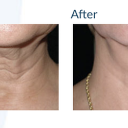 Laser Esthetica - Skin Tightening: Before & After